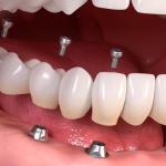 tum-agiz-implant-fiyatlari-2025