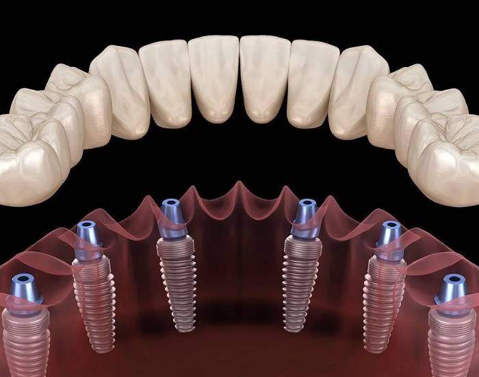 tum-agiz-implant-fiyatlari-2025-2