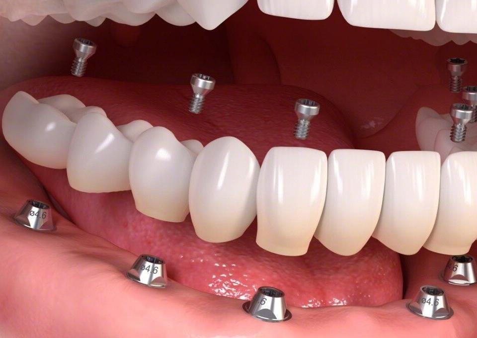 tum-agiz-implant-fiyatlari-2025